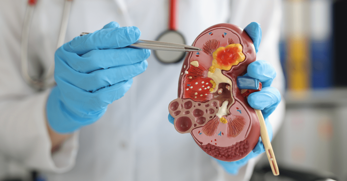 cach-day-soi-than-ra-ngoai-thumb Ways to naturally pass kidney stones