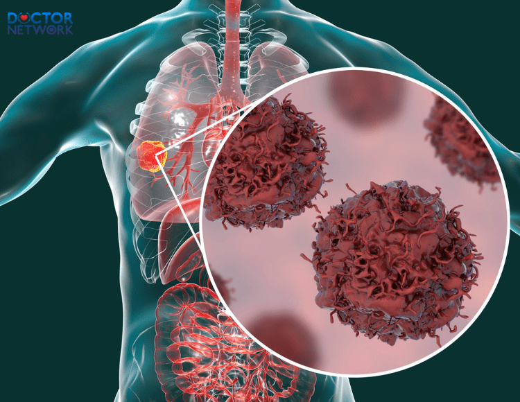 ung-thu-phoi-co-lay-khong-1