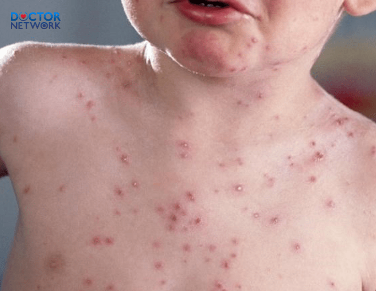 Symptoms of monkeypox 2