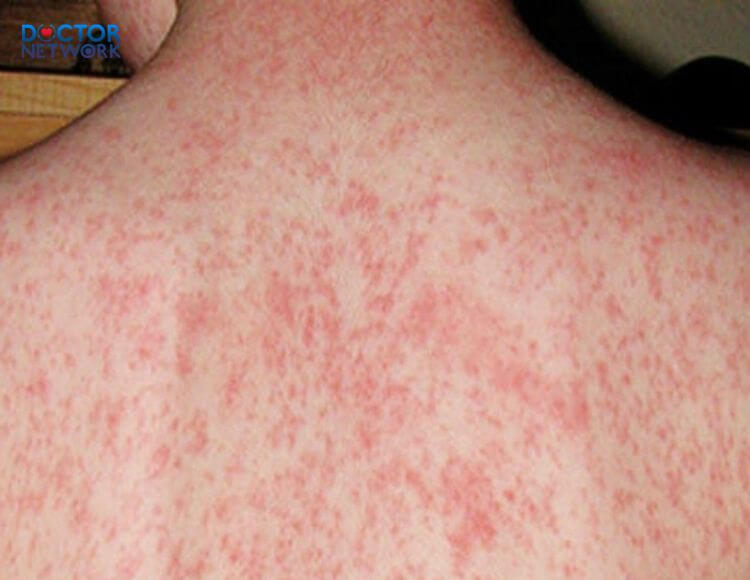 fever-with-rash-in-adults-1