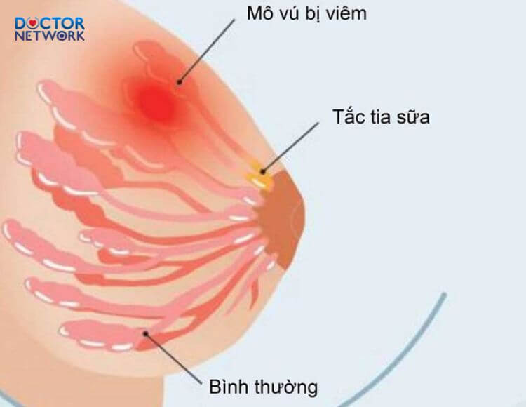 Cach-lam-tan-cuc-sua-tac-1 how to resolve blocked milk ducts