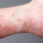 home-remedies-for-itchy-scabies-thumb Cach-tri-ghe-ngua-tai-nha-thumb