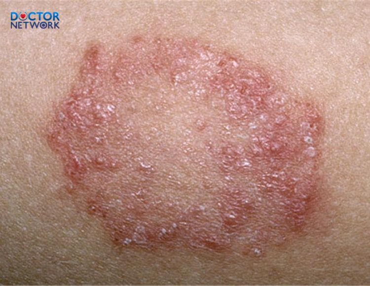 is-psoriasis-contagious-1 benh-hac-lao-co-lay-khong-1