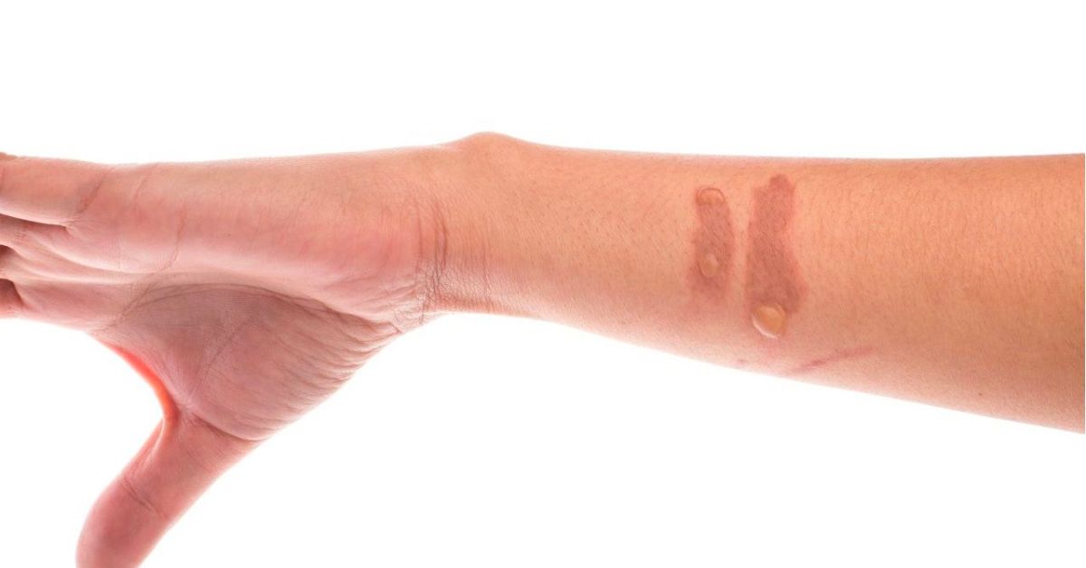 vet-bong-bi-tham-den-phai-lam-sao-thumb how-to-treat-darkened-burn-scars-thumb