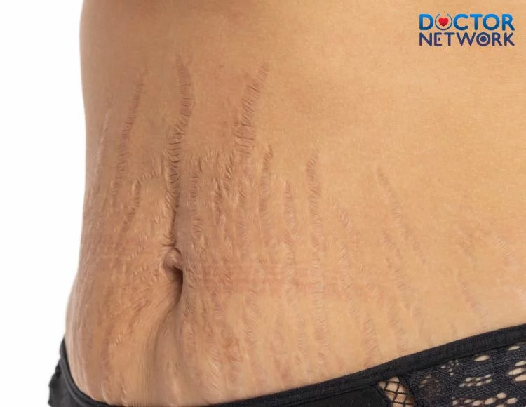 why-teens-get-stretch-marks-2