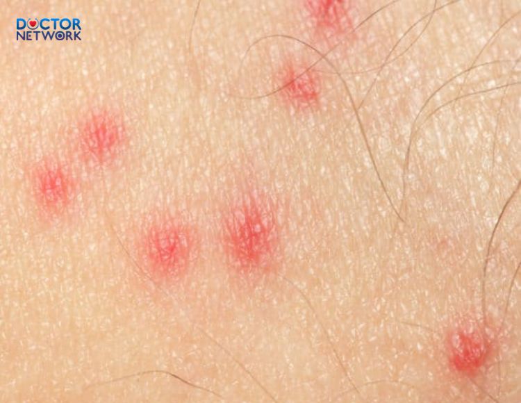 Da-noi-not-do-nhu-muoi-dot-1
skin-red-spots-like-mosquito-bites-1