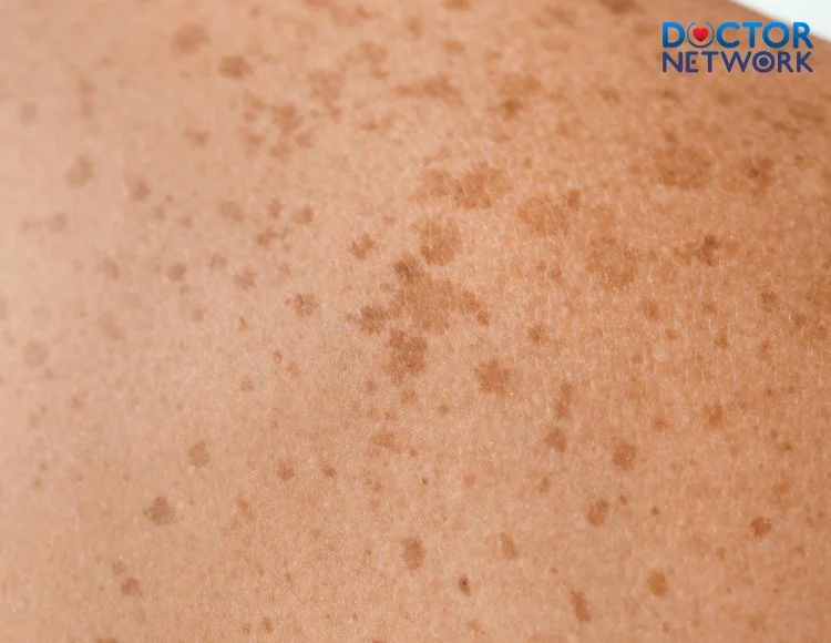 dark-spots-on-the-skin-2