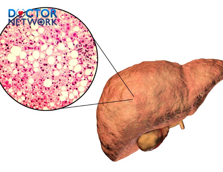 gan-nhiem-mo-do-1-1 Grade-1-Fatty-Liver