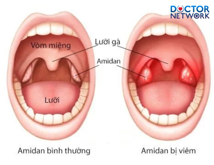 cat-amidan-co-dau-khong-1