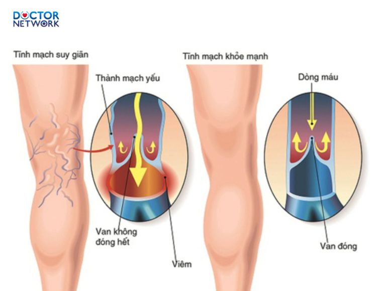 Suy-van-tinh-mach-chi-duoi-1