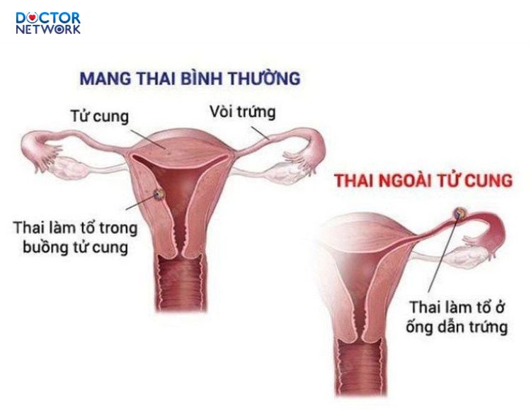 Dau-hieu-co-thai-ngoai-tu-cung-2