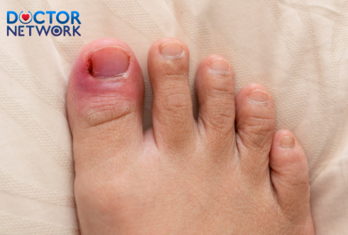 Side of Toenail Hurts But Isn't Ingrown