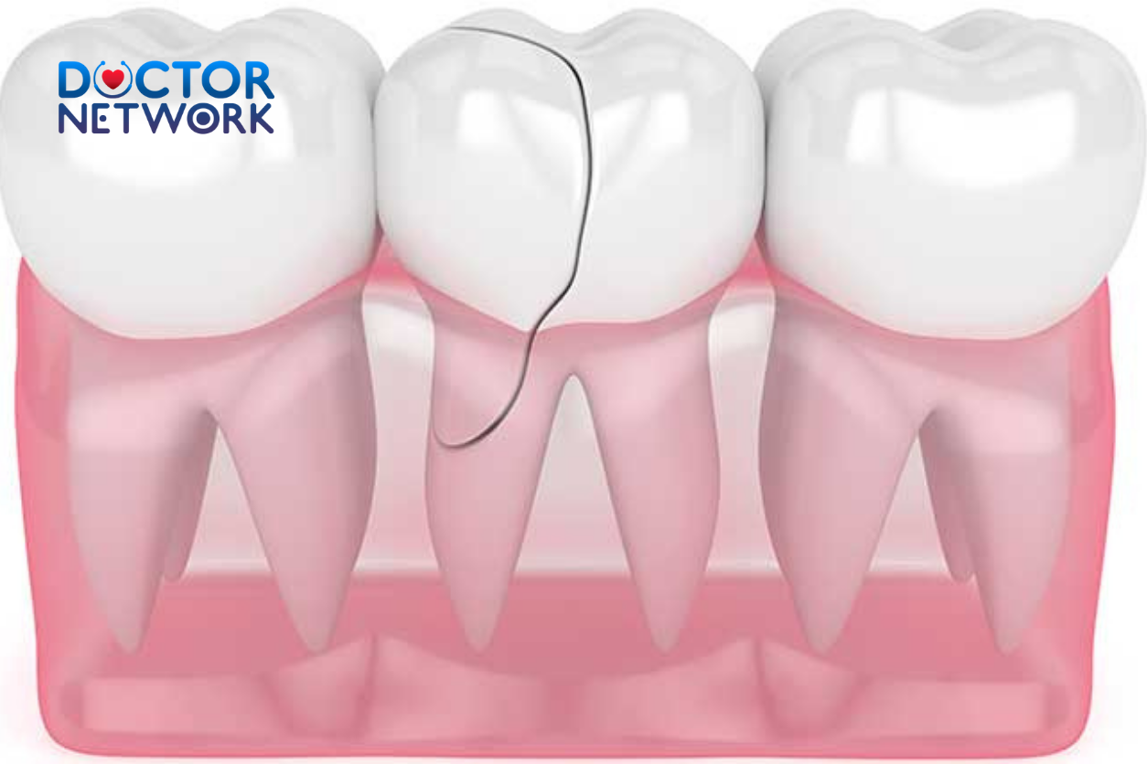 How to Fix a Cracked Tooth Naturally
