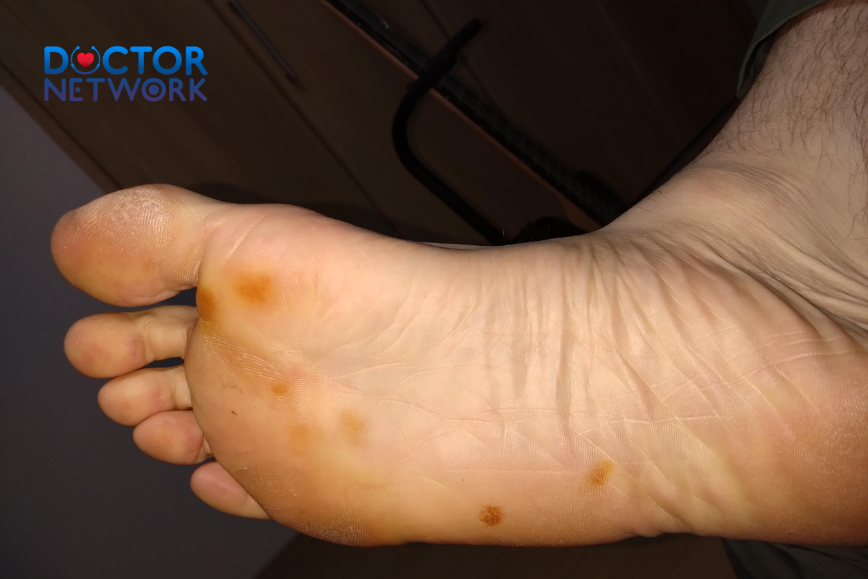 Navigating Dark Spots on Bottom of Feet: A Complete Cause for Concern 3 dark spots on bottom of feet