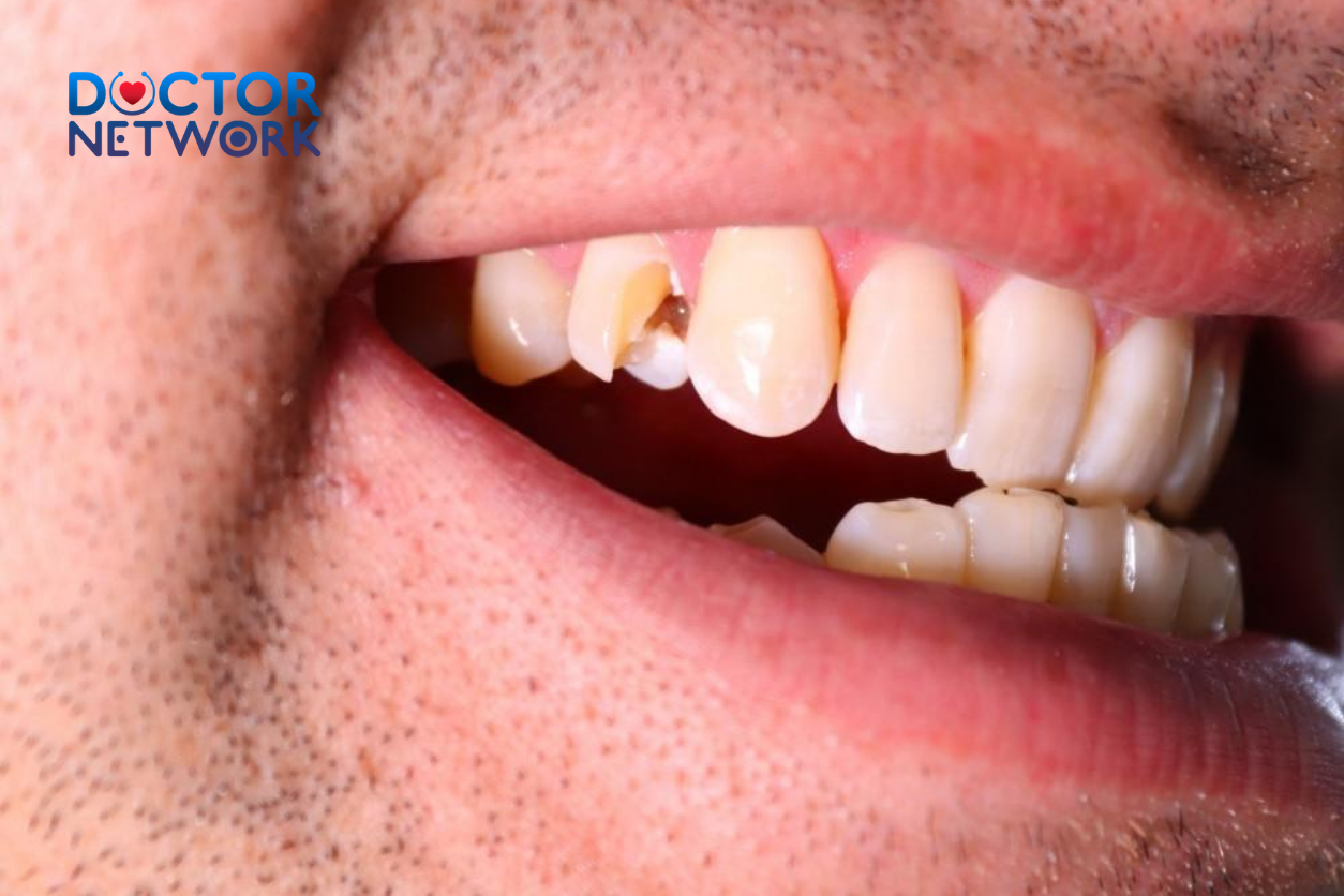 How to Fix a Cracked Tooth Naturally