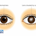 sign and symptoms of cataracts