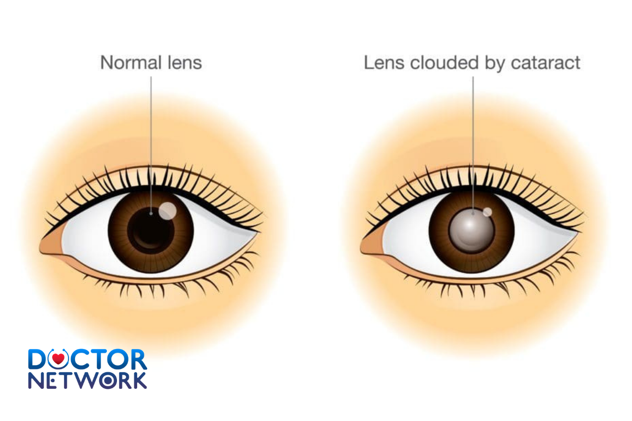 sign and symptoms of cataracts