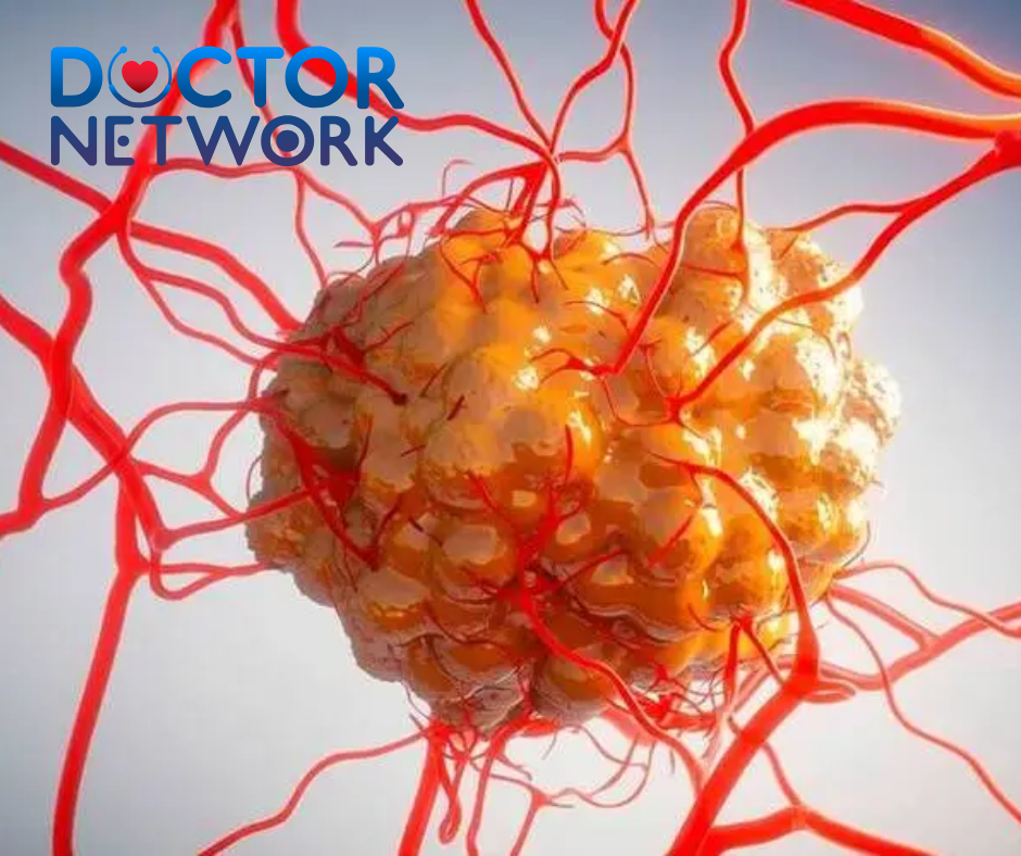 How Does Neuroendocrine Cancer Kill You